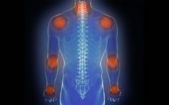 Artrite psoriasica