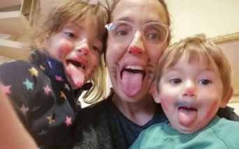 Sindrome di Beckwith-Wiedemann