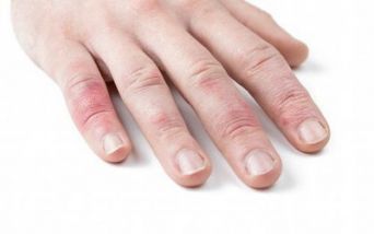Eczema