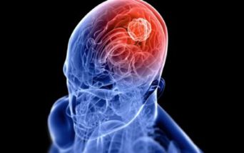 Linfoma cerebrale