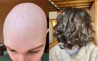 Foto di Martina prima e dopo la terapia
