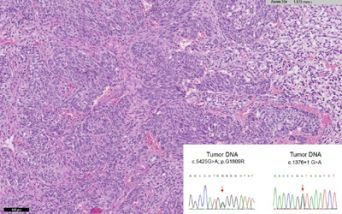 Neoplasia maligna
