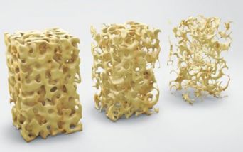 Osteoporosi