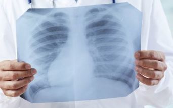 Radiografia polmonare
