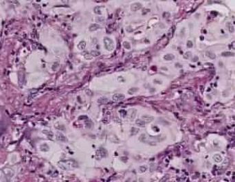 Adenocarcinoma
