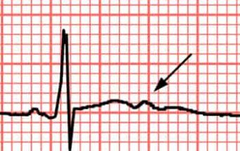 Fibrillazione atriale in elettrocardiogramma