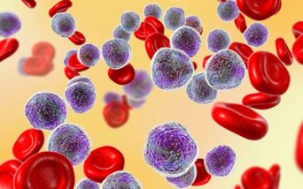 Leucemia linfoblastica acuta