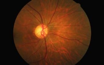 Retina