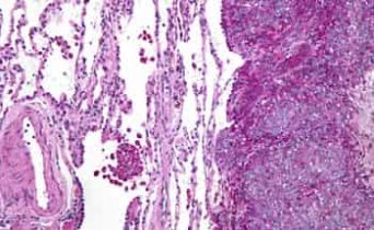 Sarcoma di Ewing