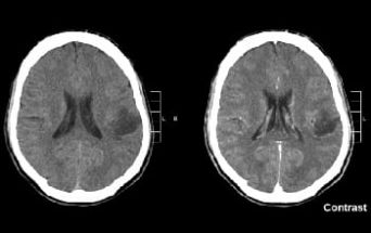 Foto di glioma